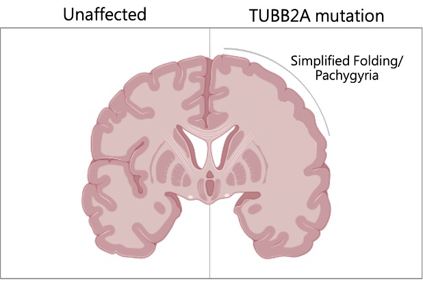 TUBB2A Mutation