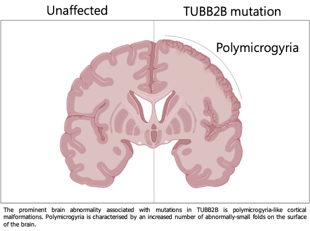 TUBB2B MUTATION