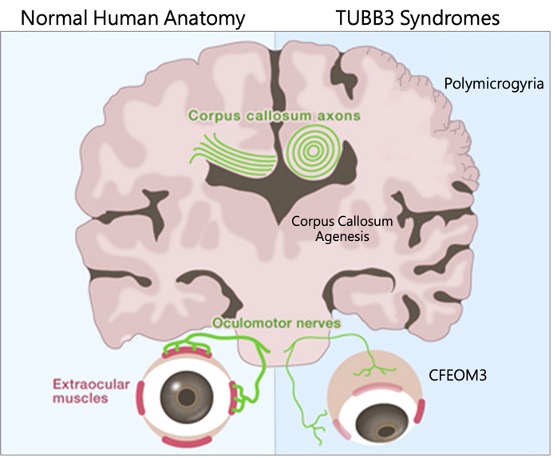TUBB3_SYNDROMES TUBB3 SYNDROMES