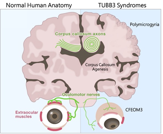 TUBB3 SYNDROMES