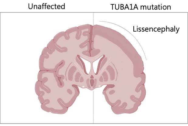 TUBA1A Mutation