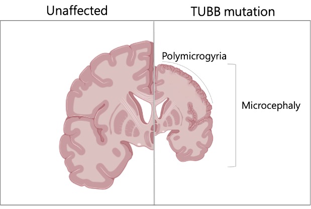 TUBB Mutation